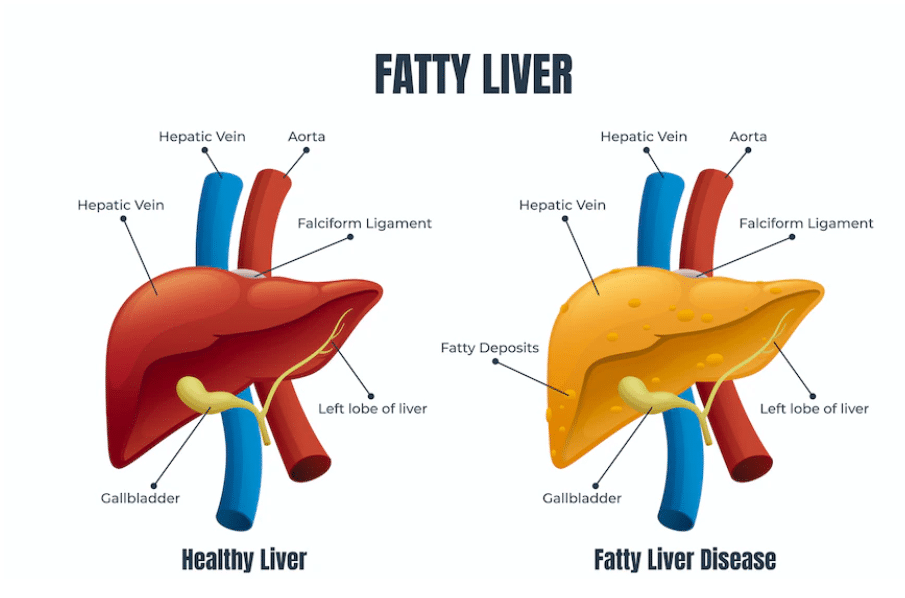 fatty liver versus healthy liver